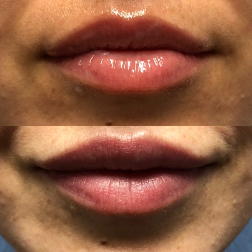 Lip Injections before and after