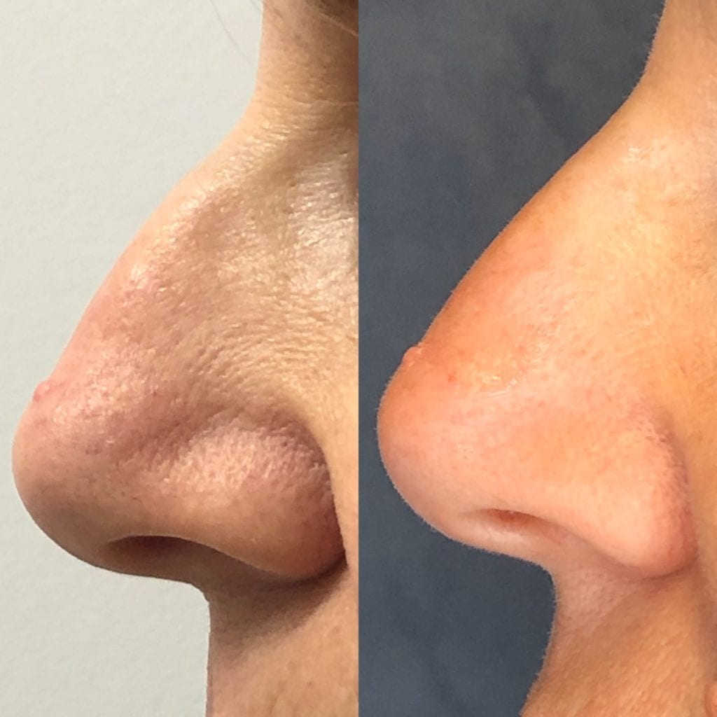 Nose Injections before and after