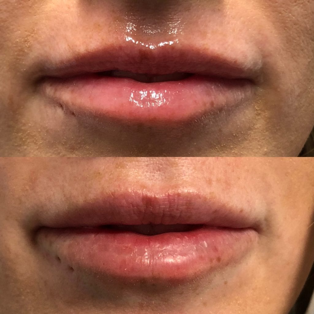 Lip Injections before and after