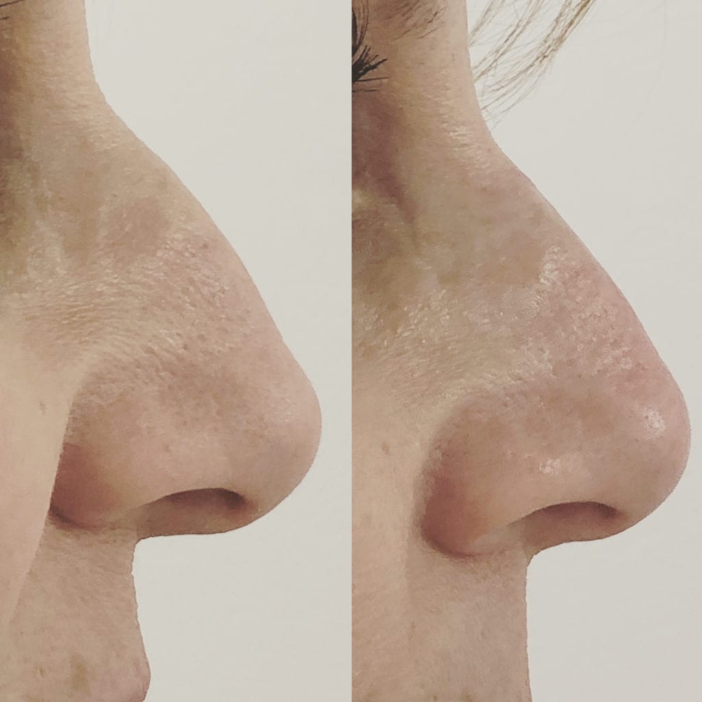 Nose Injections before and after