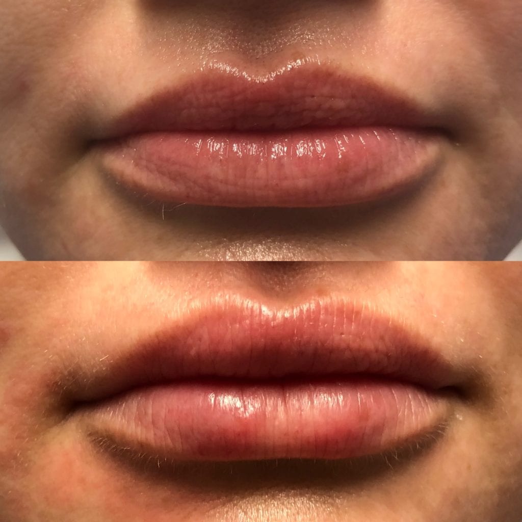 Lip Injections before and after