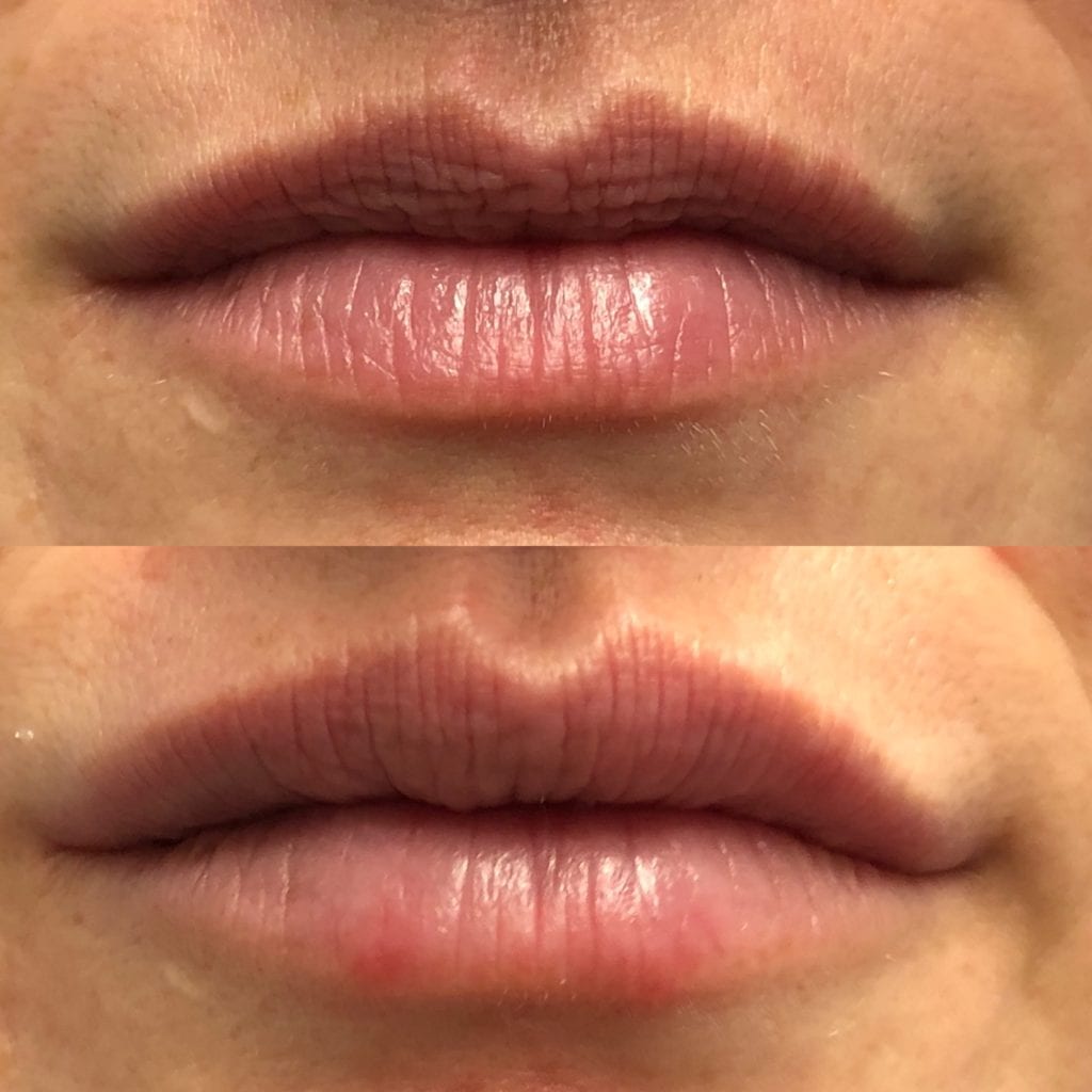 Lip Injections before and after