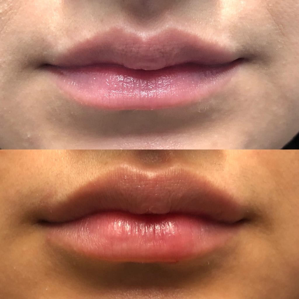 Lip Injections before and after